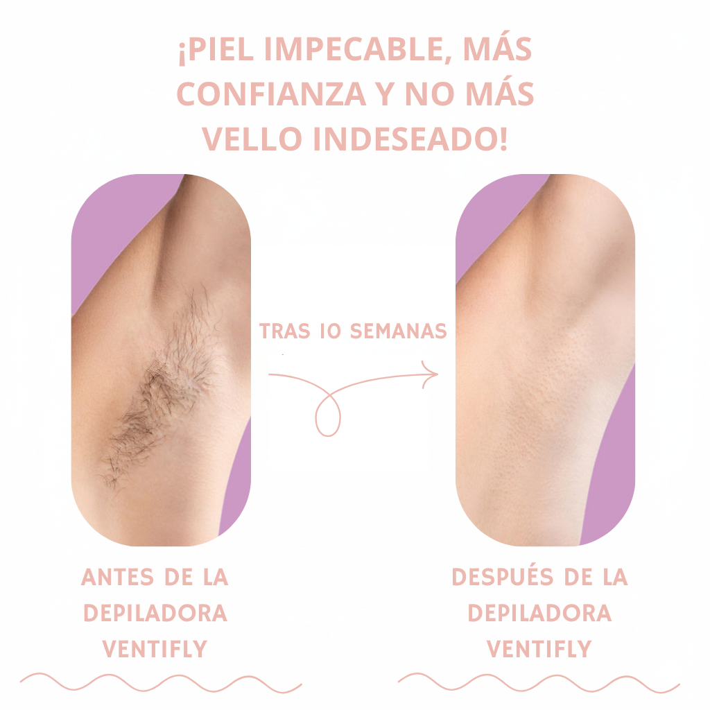 DEPILADORA LÁSER - VENTIFLY